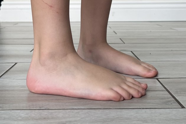 Flat feet standing