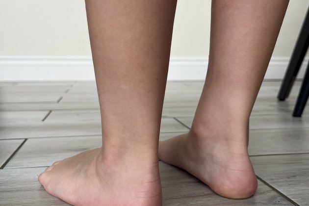 Flat feet standing 2